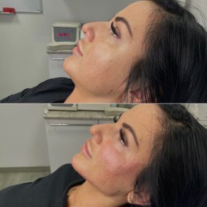 Zabieg Full Face Natural Warszawa