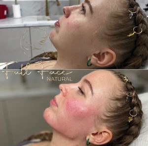 Zabieg Full Face Natural Warszawa