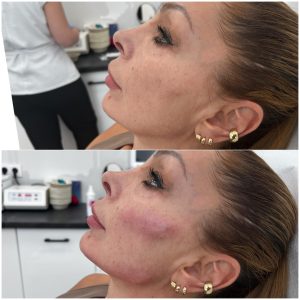 Zabieg Full Face Natural Warszawa