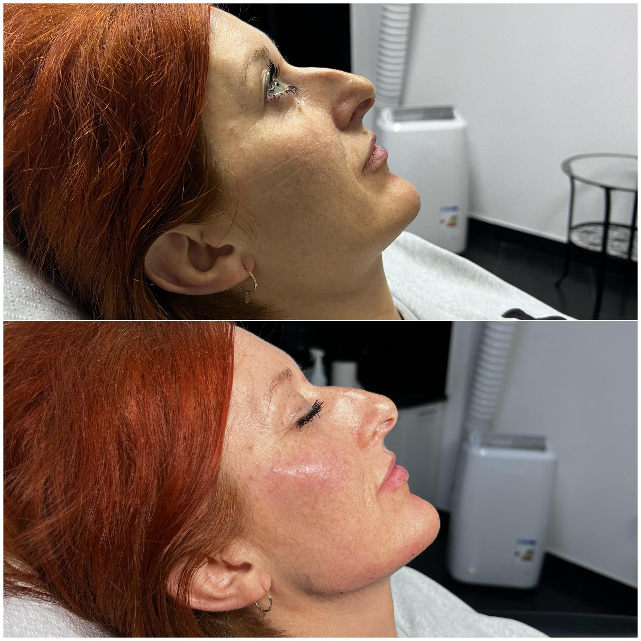 Zabieg Full Face Natural Warszawa