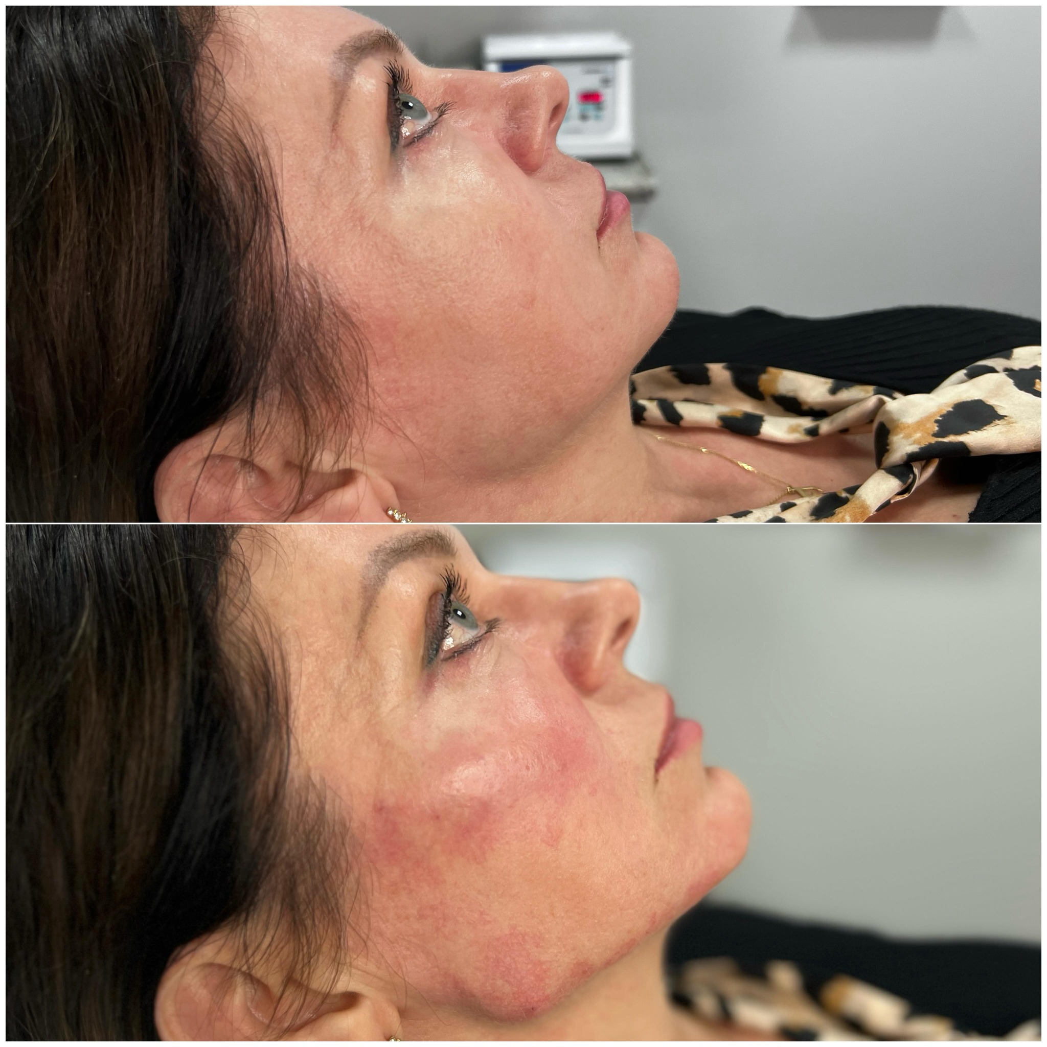 Zabieg Full Face Natural Warszawa