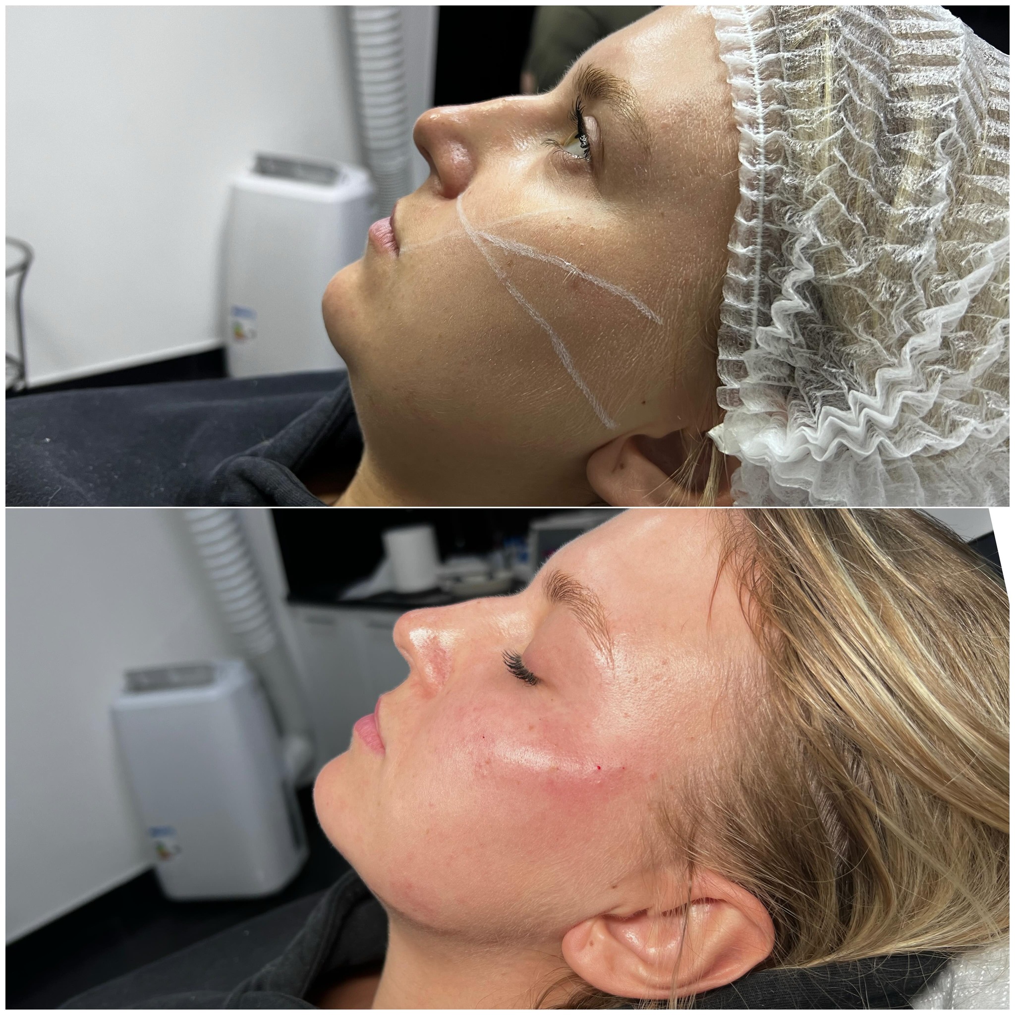 Zabieg Full Face Natural Warszawa