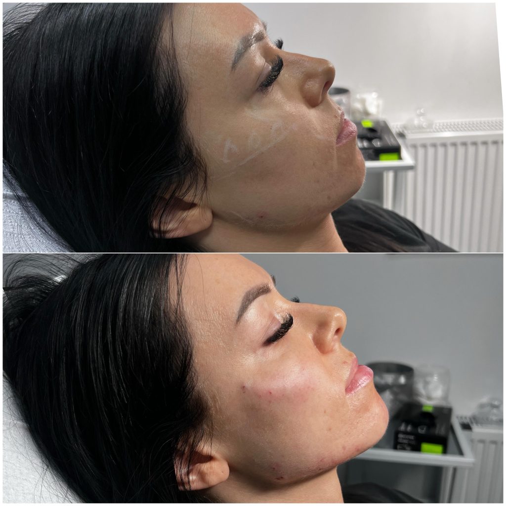 Zabieg Full Face Natural® Warszawa